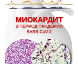 На сайте xtreker.ru вы можете прочитать книгу Миокардит в период пандемии SARS-CoV-2 под авторством Е. А. Коган, О. В. Благова бесплатно и без регистрации. Скачать книгу в формате FB2, TXT, RTF, EPUB. 70227961. На сайте xtreker.ru вы можете прочитать книгу Миокардит в период пандемии SARS-CoV-2 под авторством Е. А. Коган, О. В. Благова бесплатно и без регистрации. Скачать книгу в формате FB2, TXT, RTF, EPUB фото. На сайте xtreker.ru вы можете прочитать книгу Миокардит в период пандемии SARS-CoV-2 под авторством Е. А. Коган, О. В. Благова бесплатно и без регистрации. Скачать книгу в формате FB2, TXT, RTF, EPUB-70227961. картинка На сайте xtreker.ru вы можете прочитать книгу Миокардит в период пандемии SARS-CoV-2 под авторством Е. А. Коган, О. В. Благова бесплатно и без регистрации. Скачать книгу в формате FB2, TXT, RTF, EPUB. картинка 70227961. Монография посвящена новому заболеванию, которое стало известно как COVID-19. Авторам принадлежит приоритет (как минимум в России) в описании острого коронавирусного миокардита с выделением РНК вируса из ткани миокарда, сделанного на основании анализа аутопсийного материала. Первые главы содержат анализ литературы относительно патогенеза поражения сердца при новой коронавирусной инфекции, а также описание первых и последующих случаев миокардита при COVID-19 в зарубежных публикациях с подробным изложением собственных исследований морфологии и проявлений этого миокардита. Отдельная глава посвящена вопросам иммунных, воспалительных и аутоиммунных реакций.